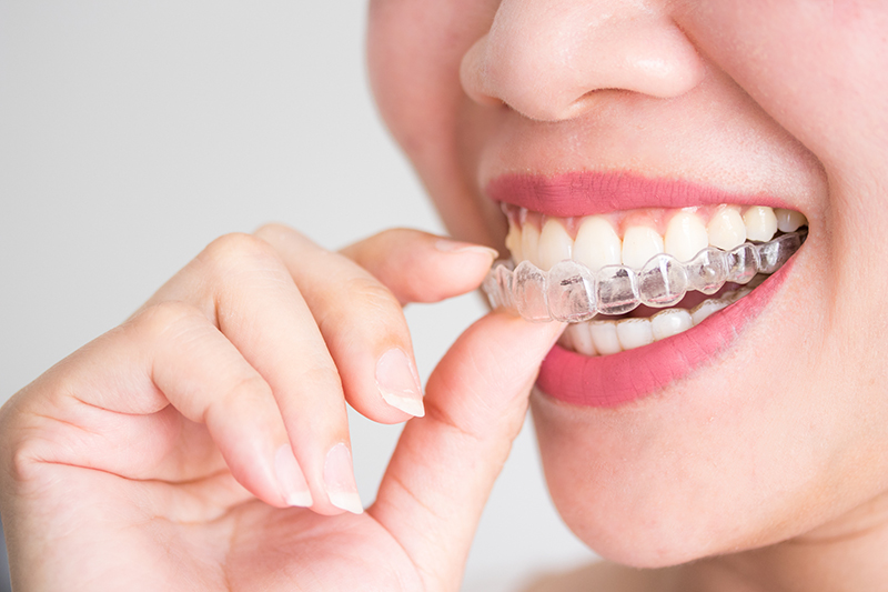 Invisalign consultation at Smile 4 U Chislehurst
